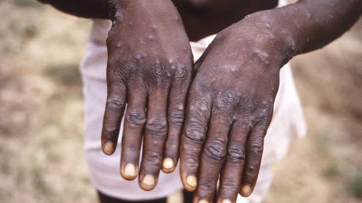 Mpox dans le Haut-Katanga : Réalité alarmante ou manque de communication