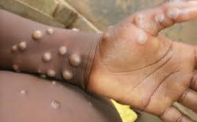RDC : Plus de 1 200 cas de mpox enregistrés au Nord Kivu